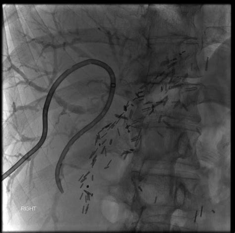 Percutaneous transhepatic cholangiography catheter placed in one of the ...