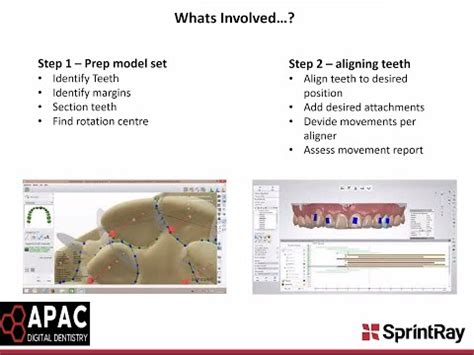 D Printer In The Digital Orthodontic Workflow And Diy Clear Aligners