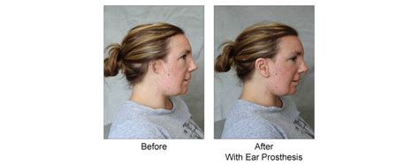 Auricular (Ear) Prosthesis for Osseointegrated Ear Implant | Custom ...