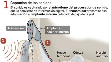 Video El Implante Coclear Un Antes Y Un Despu S En El Tratamiento De