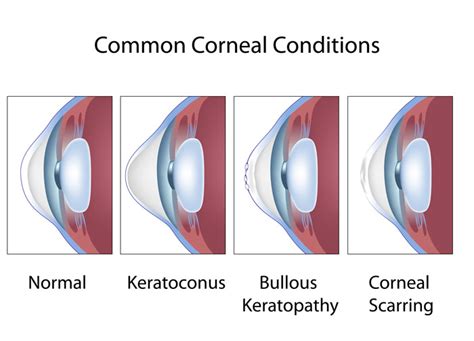 cornea diseases  treatments south east eye