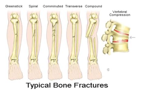 Fractures Flashcards Quizlet