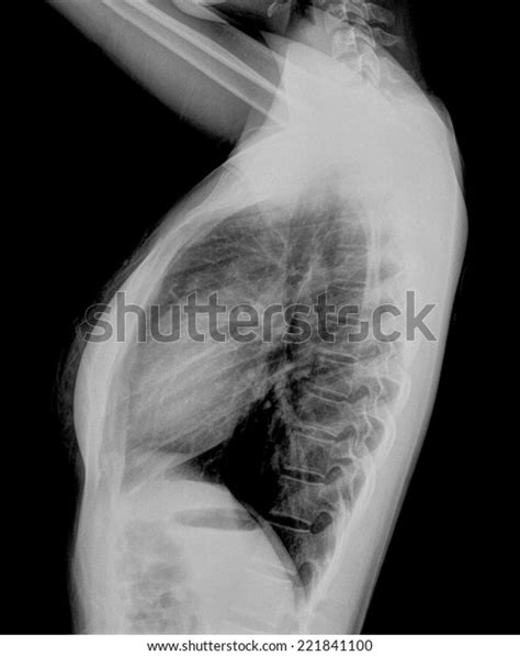 Human Thorax Radiography Side View Stock Photo Edit Now 221841100