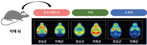 알츠하이머병 신경전달물질 변화 Pet 영상으로 규명치료제 개발 가능성 제시