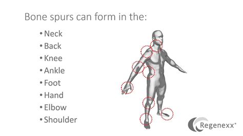 Hip Bone Spur Removal - Why You Should Avoid It - Regenexx®