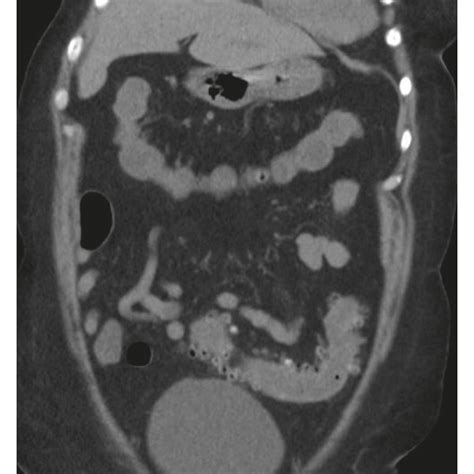 Ct Abdomen And Pelvis Without Contrast Showing Mild Inflammation Download Scientific Diagram