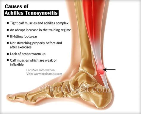 Tenosynovitis Ankle