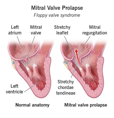 Mitral Valve Diseases İstanbul Turkey Macit Bitargil