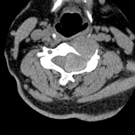 Cervical Spinal Neurofibroma In A Patient With Nf Radiopaedia