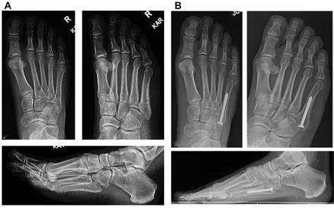 Jones Fracture Management In Athletes Orthopedic Clinics