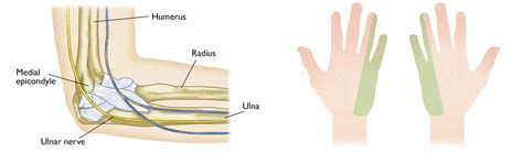 Cubital Tunnel Syndrome — Miami Bone And Joint Institute Premier Center