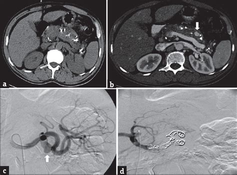 Contrast Enhanced Computed Tomography Imaging Of Splenic Artery