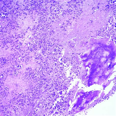 Pdf Stromal Osseous Metaplasia In Ovarian Serous Cystadenocarcinoma