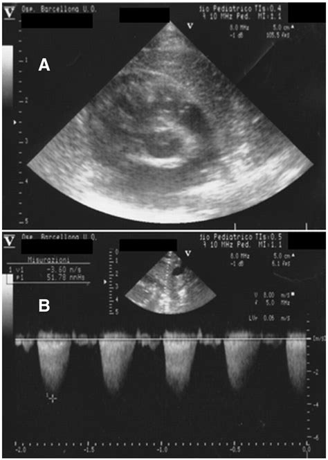 Isolated Supravalvular Pulmonary Stenosis In A 25 Day Old Newborn Infant An Occasional And