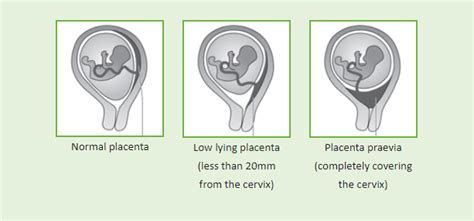 Placenta Previa During Pregnancy Facts You Need To Know