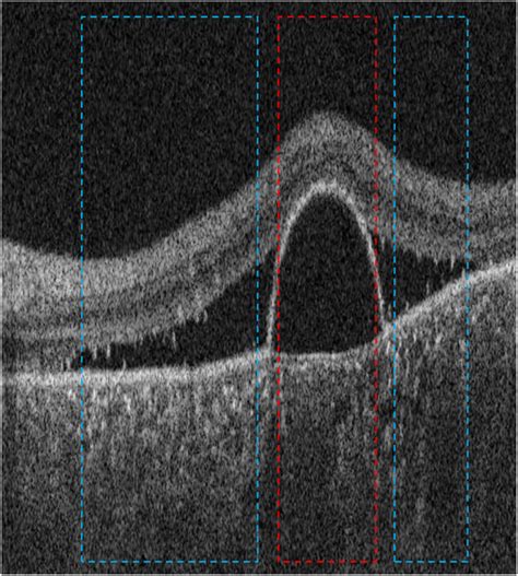 Amplitude Scan Classification Using Artificial Neural Networks