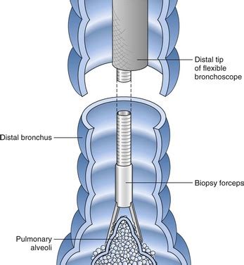 Bronchoscopy | Thoracic Key