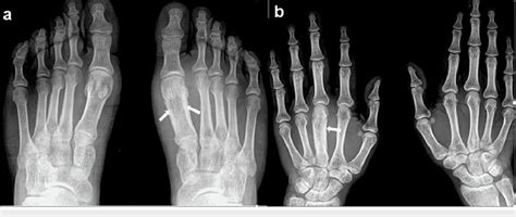 Chronic Recurrent Multifocal Osteomyelitis CRMO In A 20 Year Old Male