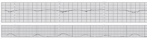 Abnormal Fetal Heart Rate Patterns Department Of Obstetrics And