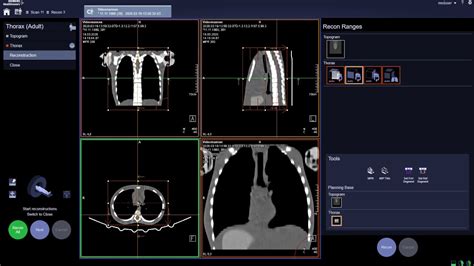 Ct Somatom Goup Thorax K Grensesnitt Og Radiografens Arbeidsflyt