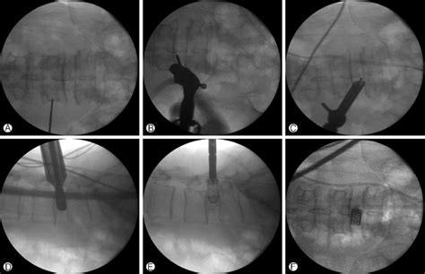 Intraoperative Fluoroscopic Images Showing Steps Of Endo Lm Tlif