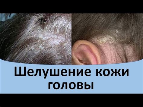 Лечение сухой и жирной кожи головы народными средствами