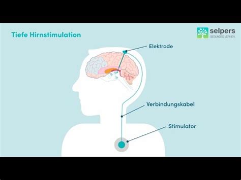 Morbus Parkinson Tiefe Hirnstimulation Experte Erkl Rt Youtube