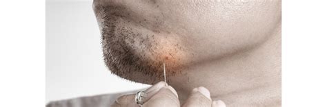 How To Prevent And Treat Ingrown Hair