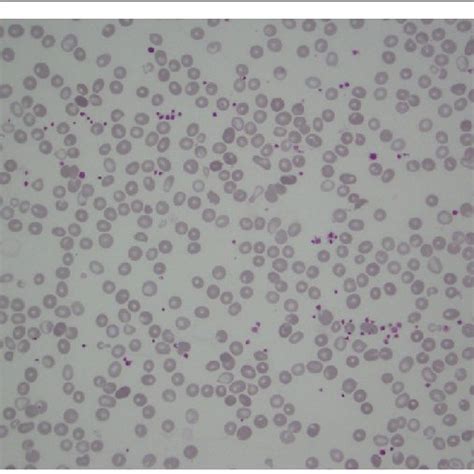 Blood smear obtained a week after the beginning of the treatment ...