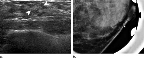 Correlation Of Mammographic And Us Findings Mammography Performed At