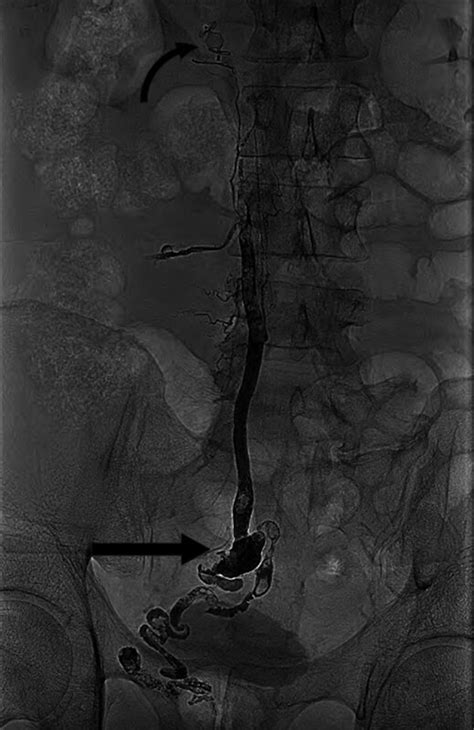 Postembolization Fluoroscopic Spot Image Showing Glue Cast In The