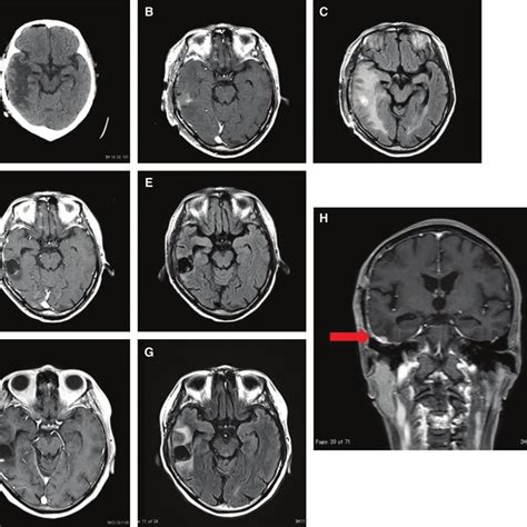 Postoperative Images A C Postoperative MRI Showing Removal Of The