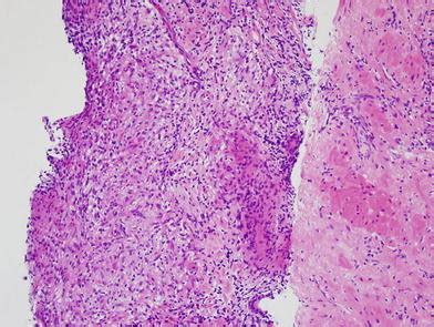 H E Stained Slide From A Prostate Needle Core Biopsy With Non Specific