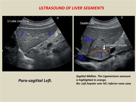 Presentation1 Abdominal Ultrasound Anatomy