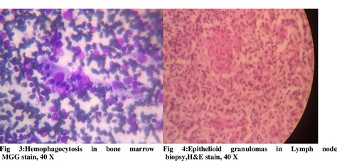 Figure 1 From Hemophagocytic Syndrome Secondary To Tuberculosis A Rare