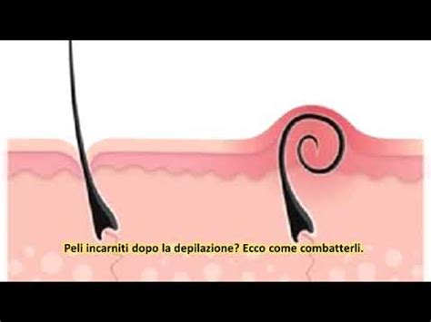 Peli Incarniti Dopo La Depilazione Ecco Come Combatterli YouTube