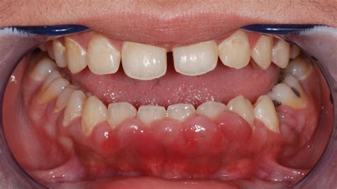 Gingivahyperplasie Doccheck Flexikon