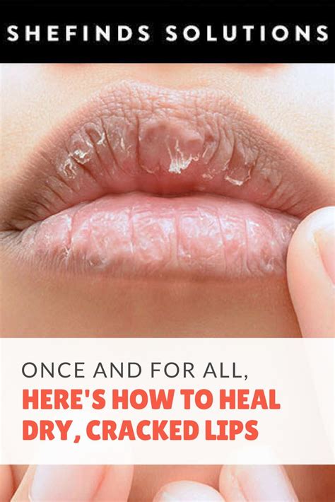 Once And For All Heres How To Heal Dry Cracked Lips