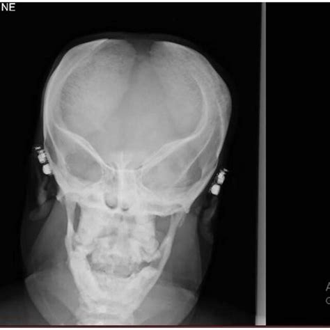 Skull X-ray (Case 1). | Download Scientific Diagram