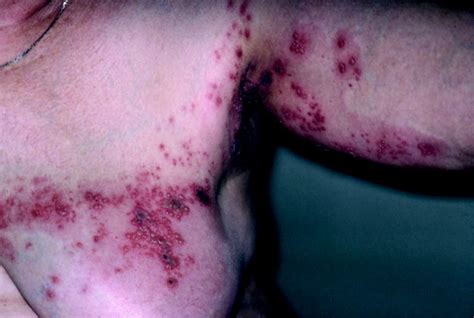 Cutaneous Manifestations Of Internal Malignancy Thiers 2009 Ca A Cancer Journal For