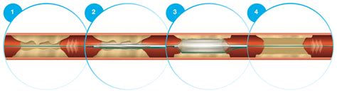 Scoreflex Orbusneich