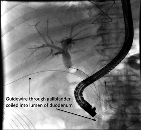 Percutaneous Cholecystostomy as a Bridge to Definitive Endoscopic ...