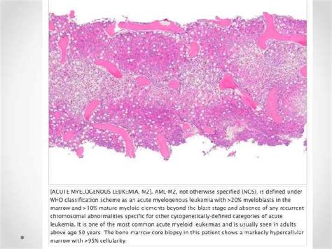 Department Of Pathological Anatomy Acute Myeloid Leukemia Prepared