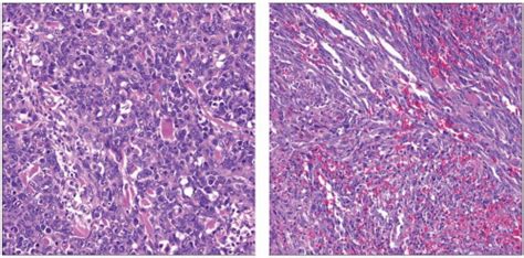 Cutaneous Angiosarcoma Basicmedical Key