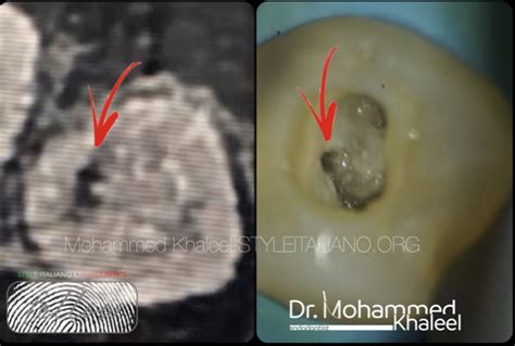 Dens invaginatus - Style Italiano Endodontics