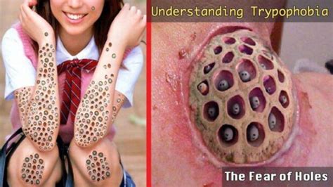 Holes In Skin Disease Trypophobia A Pictures Of Hole