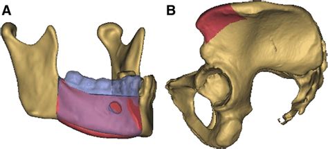 Primary Reconstruction Of The Mandible A For Primary Reconstruction Download Scientific