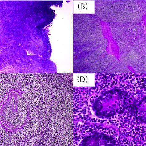 PDF Surface CD3 Negative Monomorphic Epitheliotropic Intestinal T