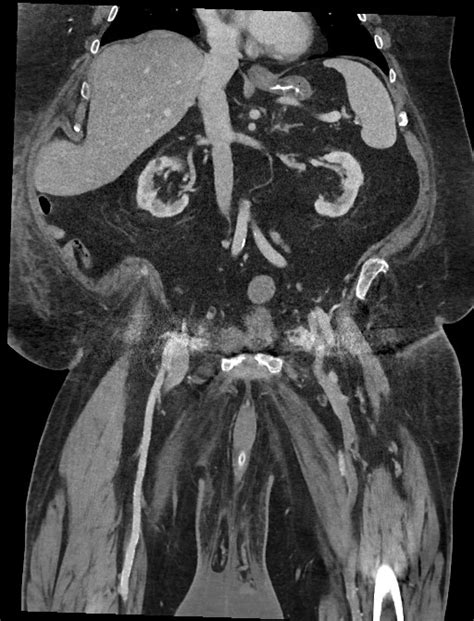 Squamous Cell Carcinoma Of The Penis Image