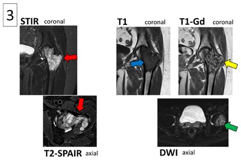 Atypical Mri Presentation Of High Grade Chondrosarcoma In The Proximal